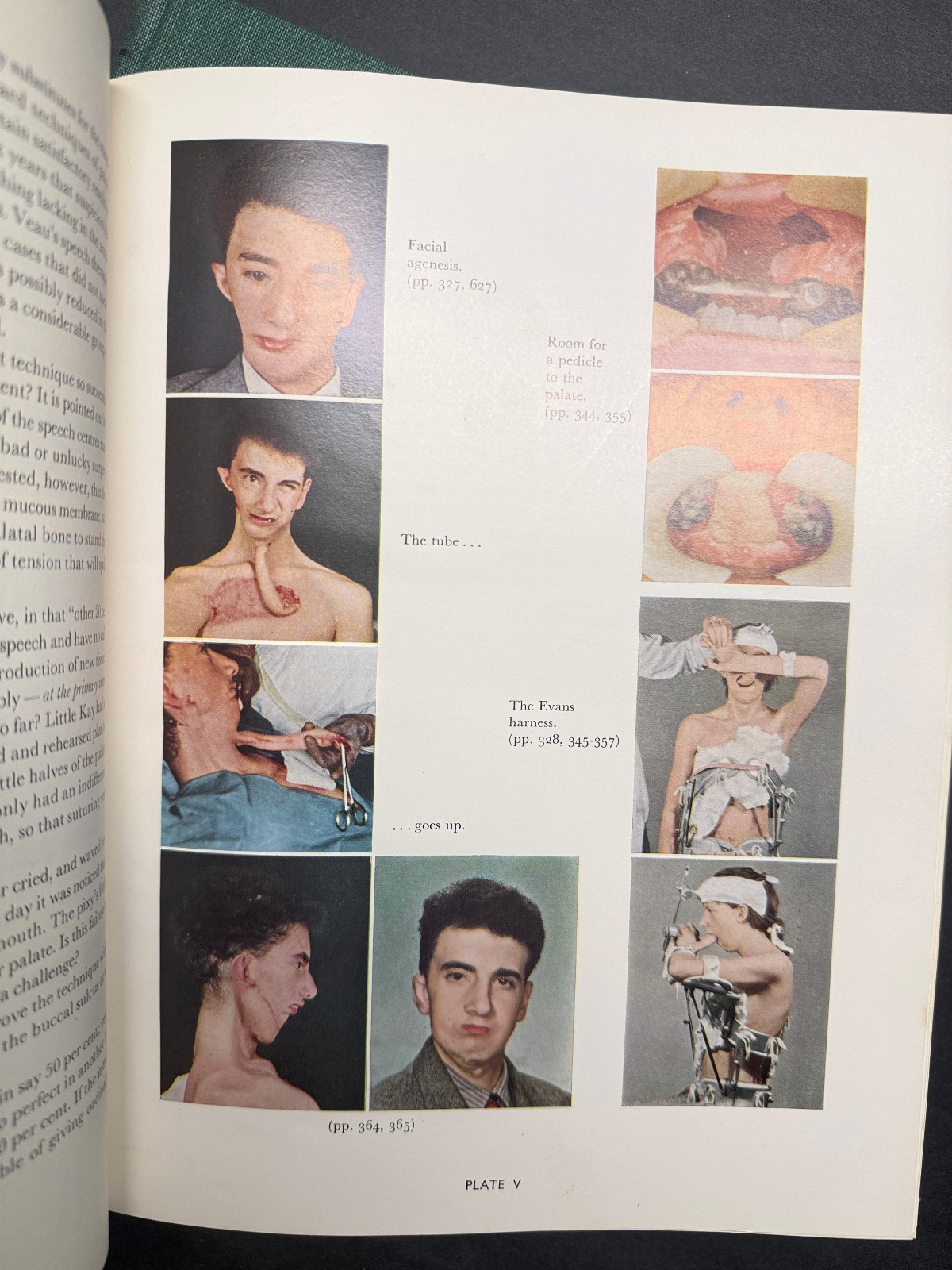 THE PRINCIPLES AND ART OF PLASTIC SURGERY GILLIES & MILLARD 1ST EDITION SLIPCASE